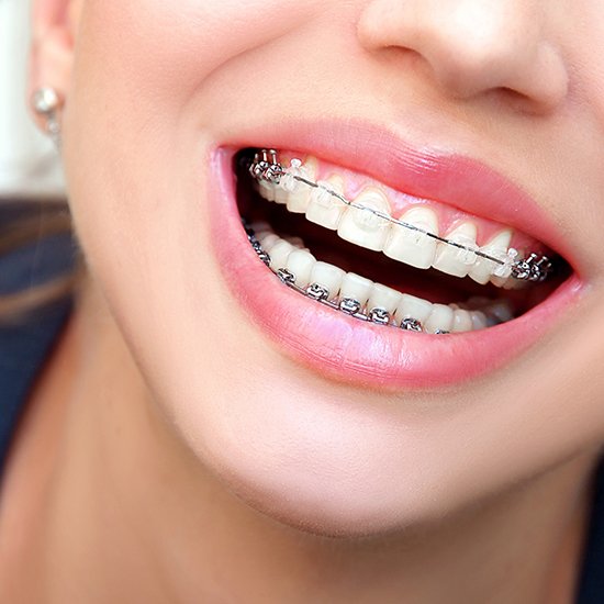 uses-of-ceramic-braces-over-metallic-braces